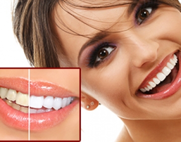 Professional Tooth Whitening