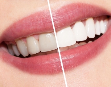 Professional Tooth Whitening