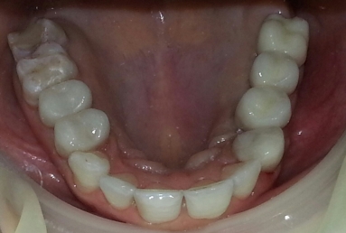 implant dentar