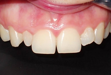 coroane si fatete ceramice