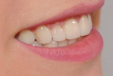 coroane si fatete ceramice