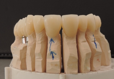 Full maxillary rehabilitation