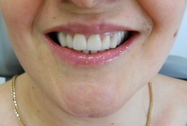 implanturi si punte ceramica