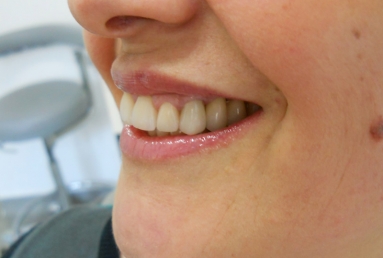 implanturi si punte ceramica