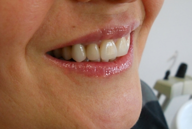 implanturi si punte ceramica