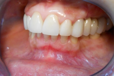 implanturi si punte ceramica