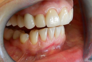 implanturi si punte ceramica