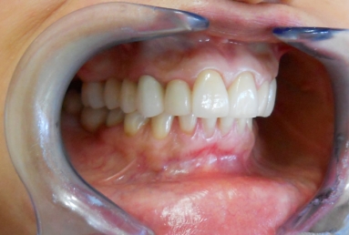 implanturi si punte ceramica