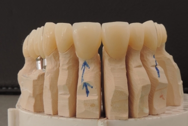 implanturi si punte ceramica