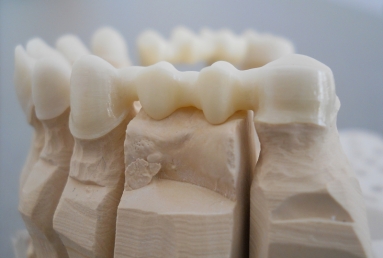 implanturi si punte ceramica