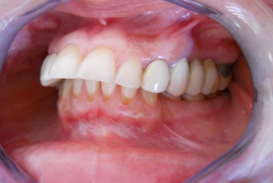 implanturi si punte ceramica