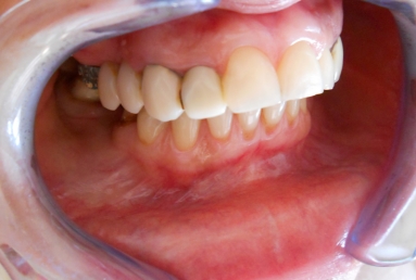 implanturi si punte ceramica