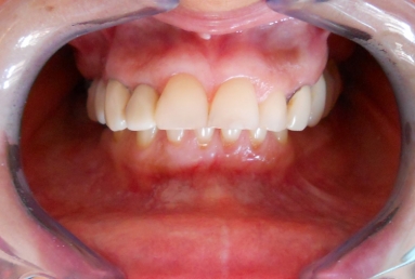 implanturi si punte ceramica