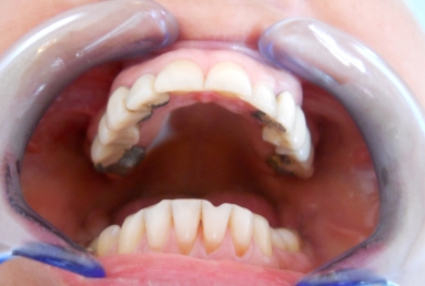 implanturi si punte ceramica