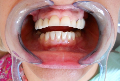 implanturi si punte ceramica