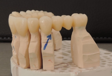 implanturi si punte ceramica