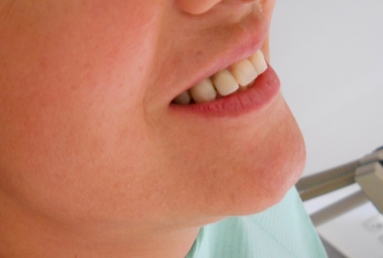 implanturi si punte ceramica