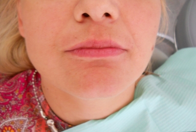 implanturi si punte ceramica