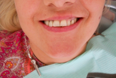 implanturi si punte ceramica