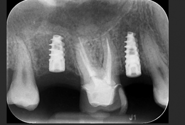 implant dentar