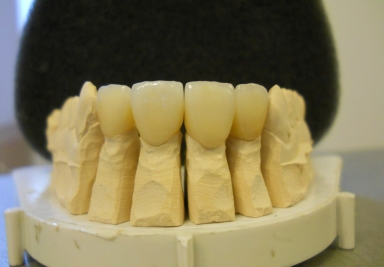 E-max full ceramic crowns