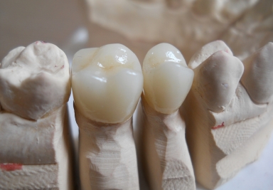 Full ceramic crowns