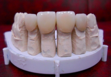 Porcelain veneers