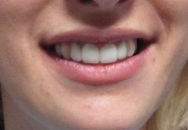 Full porcelain crowns