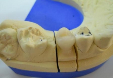 Porcelain fused to metal crown