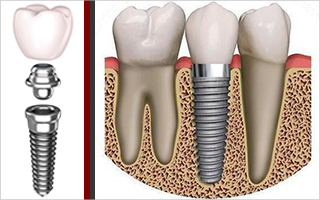 Dental implant