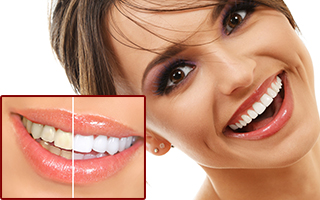 Tooth Whitening