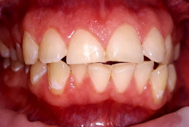 Caries front teeth