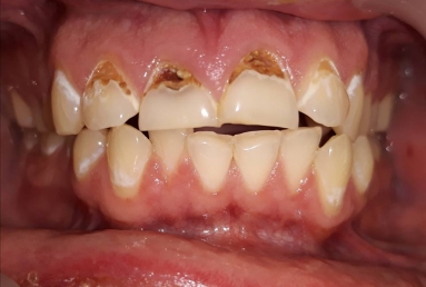 Caries front teeth