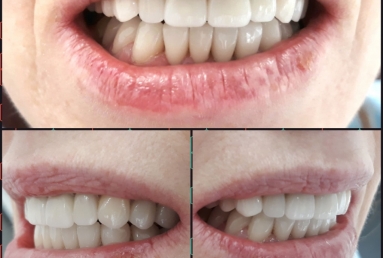Porcelain veneers, full ceramic crowns