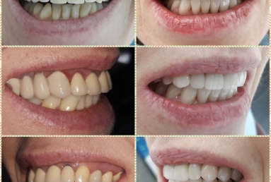 Porcelain veneers, full ceramic crowns