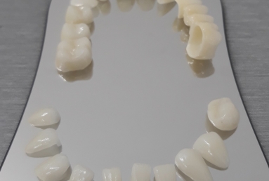 Porcelain veneers, full ceramic crowns