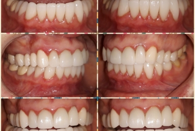Porcelain veneers, full ceramic crowns