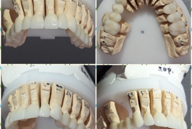 Porcelain veneers, full ceramic crowns