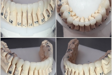Porcelain veneers, full ceramic crowns