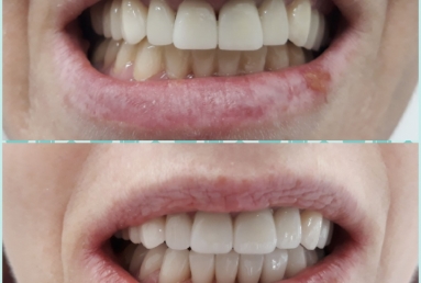 Porcelain veneers, full ceramic crowns