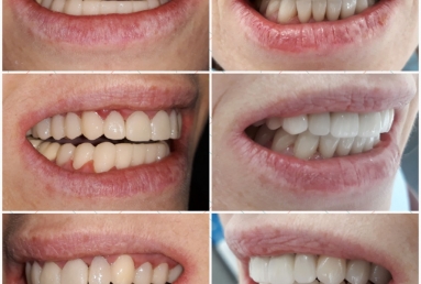 Porcelain veneers, full ceramic crowns