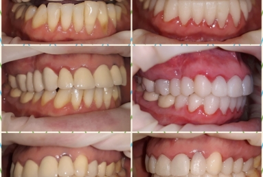 Porcelain veneers, full ceramic crowns