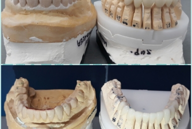 Porcelain veneers, full ceramic crowns