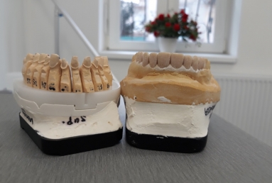 Porcelain veneers, full ceramic crowns