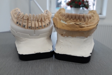 Porcelain veneers, full ceramic crowns