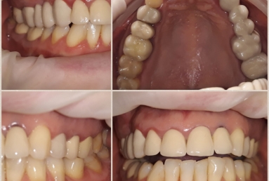 Porcelain veneers, full ceramic crowns