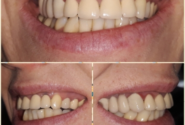 Porcelain veneers, full ceramic crowns