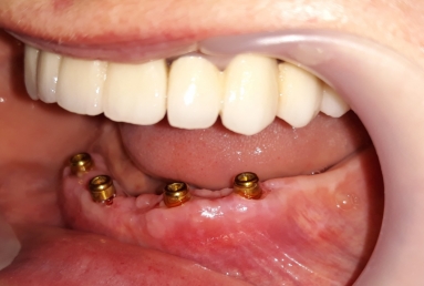 prosthetic bridges dental implant