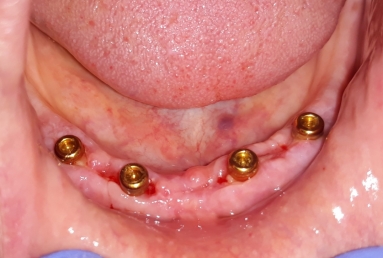 prosthetic bridges dental implant