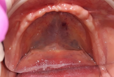 prosthetic bridges dental implant